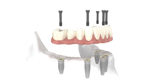 Perfect Smile Implant Bridge implant level
